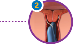 CERVIDIL is placed at vaginal fornix